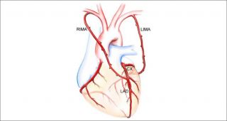 Arterial Type Coronary Artery Bypass Surgery
