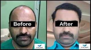 clinics prp platelet rich plasma in mumbai V Plant Advanced Hair Clinics : Beard & Moustache Transplant | Eyebrow & Hair Transplant Clinic In Mumbai | PRP | Baldness & Hair Fall Treatment | Hair Doctor | Hair Specialist in Mumbai