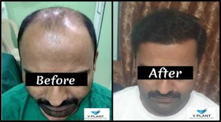 clinics prp platelet rich plasma in mumbai V Plant Advanced Hair Clinics : Beard & Moustache Transplant | Eyebrow & Hair Transplant Clinic In Mumbai | PRP | Baldness & Hair Fall Treatment | Hair Doctor | Hair Specialist in Mumbai
