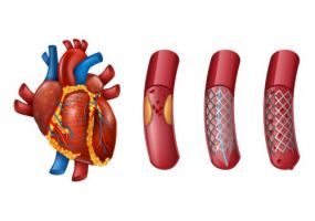 cardiologists in mumbai Dr. Kamlesh Jain- Best Cardiac Surgeon in Mumbai | Heart Specialist in Mumbai | Coronary Artery Bypass Surgery in Mumbai | Minimally Invasive Cardiac Surgeon in Mumbai | TAVI Surgery in Mumbai | Vascular Surgeon in Mumbai