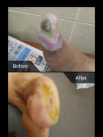 Case of Diabetic foot gangrene cured in 15-20 days without any antibiotics & with Ozone bagging & MAHT.