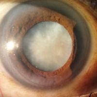 Adult Cataract Surgery