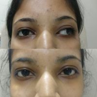 Squint before and after surgery