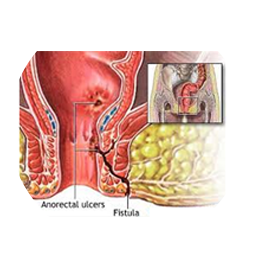An anus Fistula is a tunnel that runs from inside of the anus the part from which the body gets.