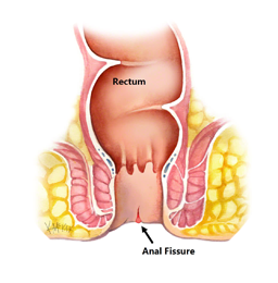 An anal tear (fissure) causes pain around the back passage (anus).The pain can be really bad and tends