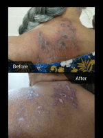 Case of Herpes zoster, treated in just 4 - 5days only with ozonated saline.