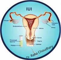 ovarian reserve analysis mumbai Dr Rana Choudhary - Best Gynecologist, Best Obstetrician, Best IVF (Fertility) Specialist