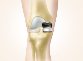 knee specialists in mumbai Dr. Santosh Shetty Best Knee and Hip Joint Replacement Surgeon. Joint Pain Specialist Clinic. Best Orthopedic Surgeon Malad Mumbai