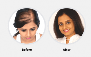 hair analysis mumbai Richfeel Trichology Centre