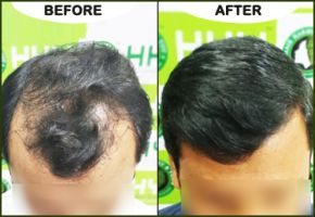 hair graft clinics in mumbai Hair Harmony and You - Best Hair Transplant Clinic In Mumbai