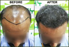 hair graft clinics in mumbai Hair Harmony and You - Best Hair Transplant Clinic In Mumbai
