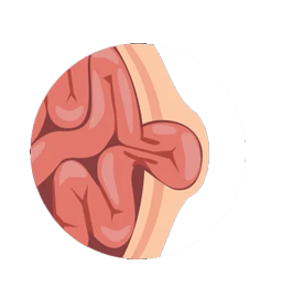 A hernia occurs when the inside layers of the abdominal wall weaken and then bulge or tear.