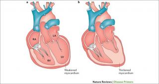 CABG in poor ejection fraction hearts