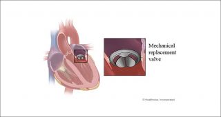 Mitral valve replacement